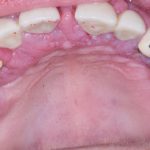 Fig. 1C Caso clinico di aumento di volume gengivale indotto dalla assunzione di nifedipina (calcio-antagonista), diffuso ad entrambe le arcate.