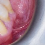 Fig. 2A Caso clinico di lesioni lupus-like indotte da isoniazide caratterizzate da aeree eritematose erosive su mucose geniene associate a fini reticoli periferici asimmetrici e placche bianche su cresta alveolare.