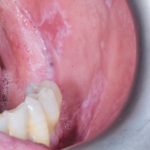 Fig. 2B Caso clinico di lesioni lupus-like indotte da isoniazide caratterizzate da aeree eritematose erosive su mucose geniene associate a fini reticoli periferici asimmetrici e placche bianche su cresta alveolare.