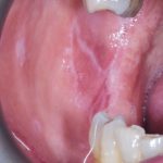 Fig. 2C Caso clinico di lesioni lupus-like indotte da isoniazide caratterizzate da aeree eritematose erosive su mucose geniene associate a fini reticoli periferici asimmetrici e placche bianche su cresta alveolare.