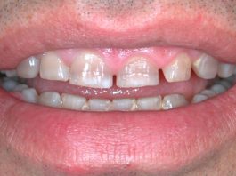 Fig. 1 Discromia da tetraciclina.