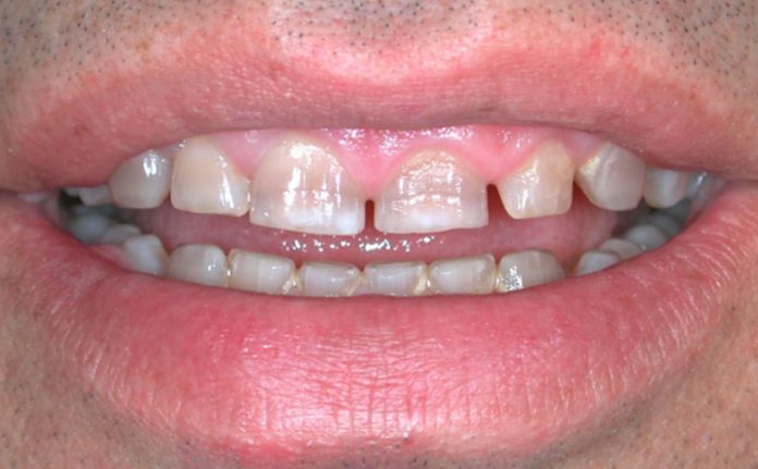 Fig. 1 Discromia da tetraciclina.