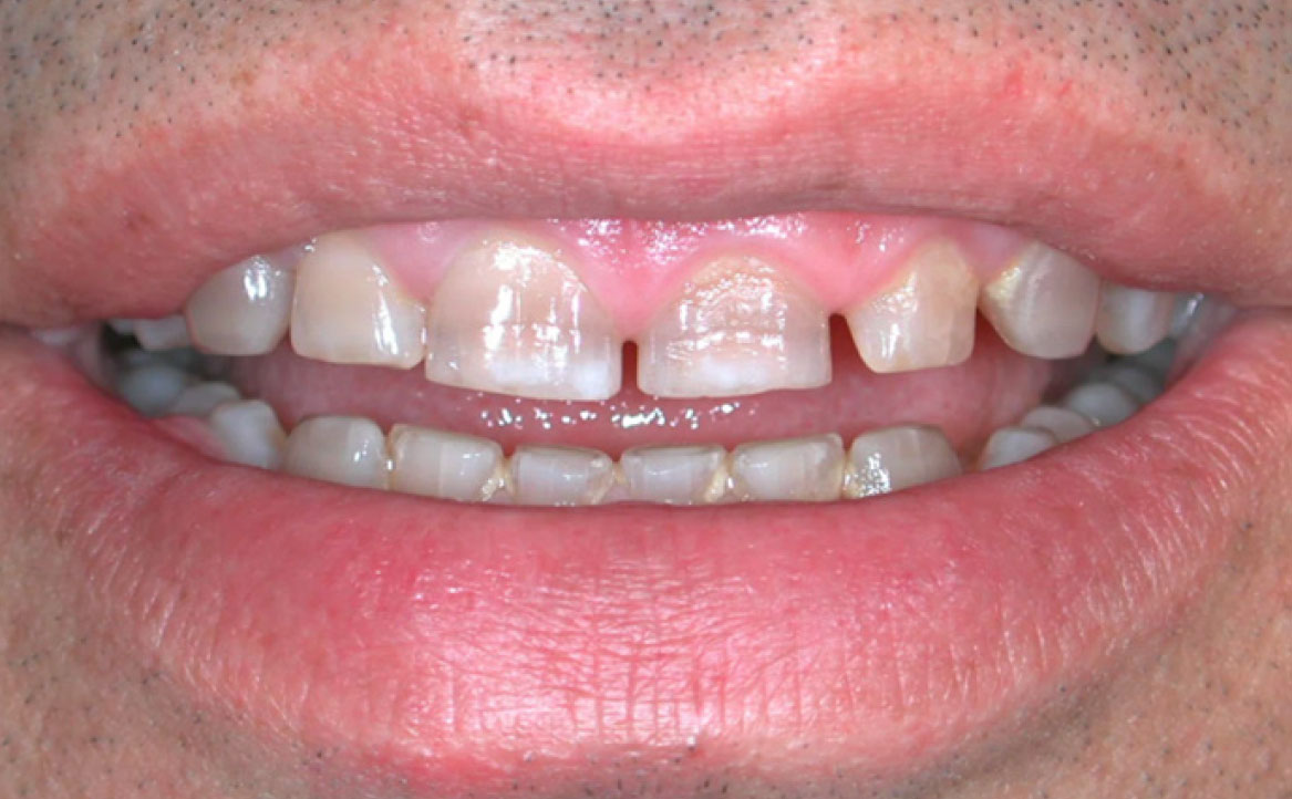 Fig. 1 Discromia da tetraciclina.