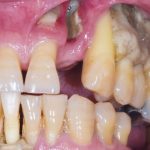 Fig. 3A Caso clinico di MRONJ diffuse in paziente oncologico che ha assunto farmaci anti-riassorbitivi ad alto dosaggio.