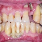 Fig. 3B Caso clinico di MRONJ diffuse in paziente oncologico che ha assunto farmaci anti-riassorbitivi ad alto dosaggio.