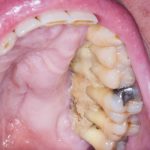 Fig. 3C Caso clinico di MRONJ diffuse in paziente oncologico che ha assunto farmaci anti-riassorbitivi ad alto dosaggio.