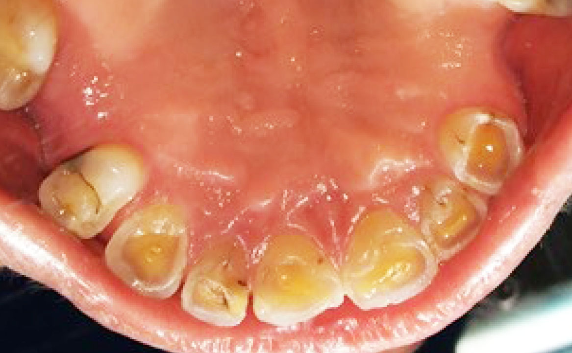 Fig. 2 Erosioni dentali.
