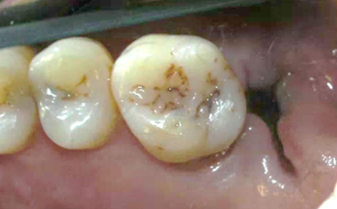 Fig. 3 Alveolite post-estrattiva.