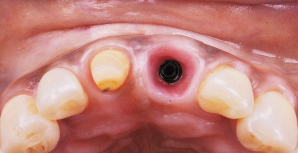 Fig. 1 Visione occlusale che evidenzia i tessuti molli parodontali e perimplantari degli incisivi centrali superiori.