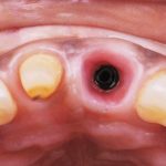 Fig. 1 Visione occlusale che evidenzia i tessuti molli parodontali e perimplantari degli incisivi centrali superiori.