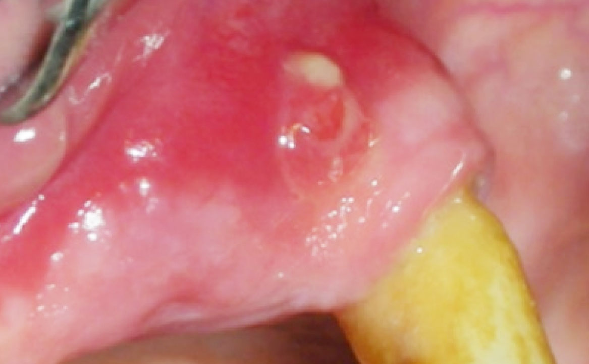 Fig. 5B Fistola mucosa (intra-orale).