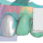 Fig. 10B Dopo aver allineato le differenti scansioni, inclusa quella del provvisorio scansito a banco e aver settato diversi livelli di trasparenze, l’odontotecnico è in grado di visualizzare i profili dei tessuti molli e la loro relazione con il provvisorio.