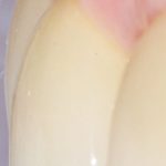 Fig. 11A Visione laterale della protesi definitiva, che mostra la transizione tra i tessuti molli perimplantari e la corona in zirconio avvitata (odt Simone Maffei).