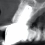 Fig. 11B La CBCT eseguita 24 mesi dopo l'intervento dimostra la stabilità dei tessuti ossei.