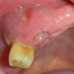 Fig. 5D Ascesso odontogeno.