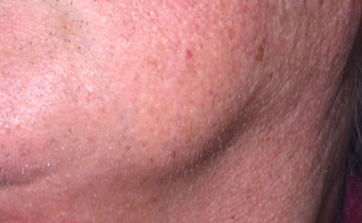 Fig. 5E Tumefazione dei tessuti molli.