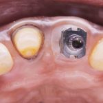 Fig. 2 Sull’elemento naturale è stato posizionato un filo di retrazione n. 000 nel solco per spostare orizzontalmente e verticalmente la gengiva marginale, mentre sul sito implantare è stato customizzato un transfer per impronta con cucchiaio aperto extraorale per supportare la mucosa perimplantare.