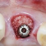 Fig. 6 È stata posizionata una vite di guarigione alta e stretta e il gap è stato riempito con un innesto osseo eterologo a granulometria fine per mantenere il volume bucco palatino e stabilizzare il coagulo.