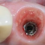 Fig. 8 Visione occlusale dei tessuti molli perimplantari cinque mesi dopo l'intervento. Si noti l'eccellente conservazione del volume.