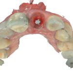 Fig. 9A Quattro delle sei scansioni intraorali (scansione dei tessuti molli, scansione del morso, scansione dello scan body e scansione extraorale della protesi provvisoria) del protocollo copy paste per una protesi implantare.