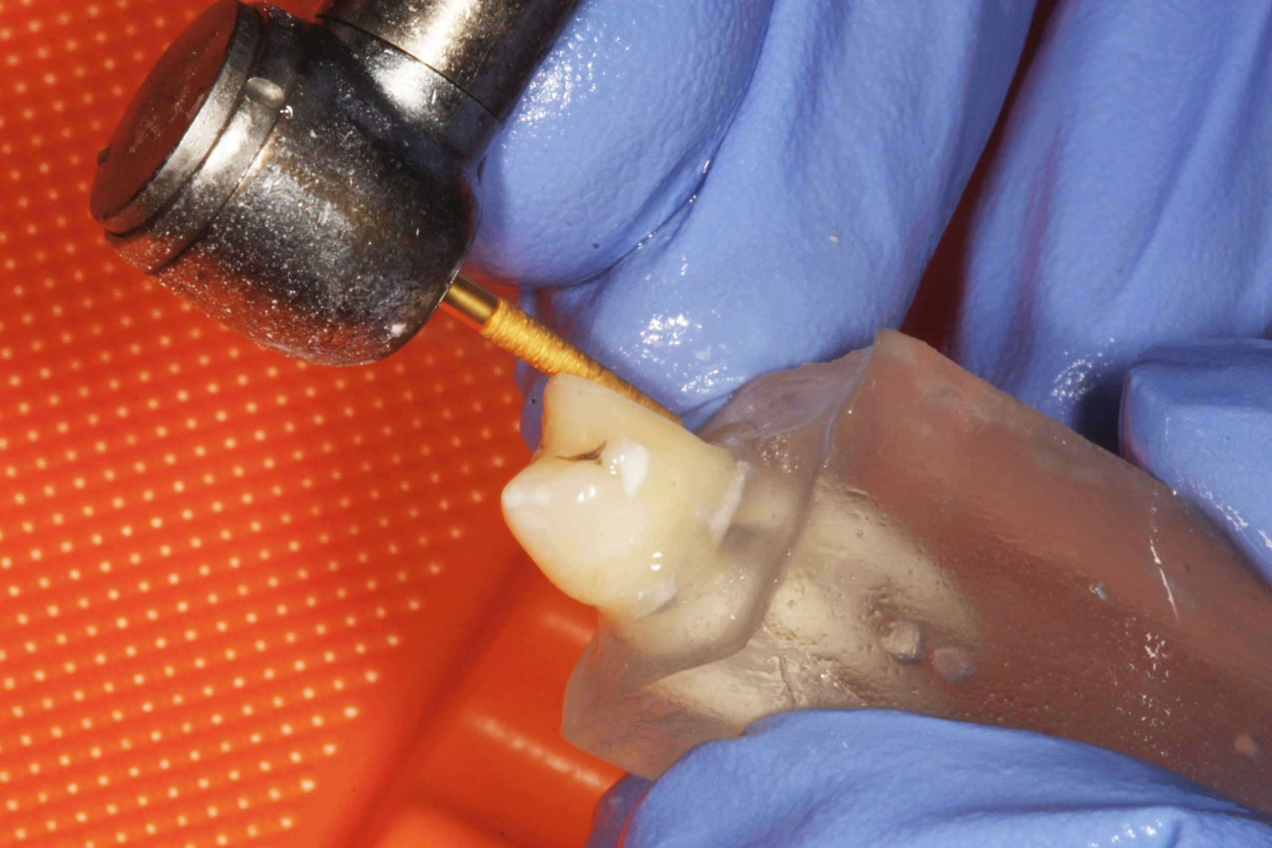 Fig. 2 Preparazione di una superficie del dente.