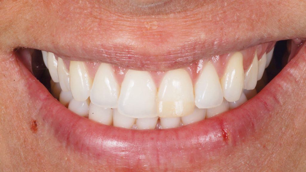 Fig. 1 Foto iniziale del sorriso in frontale.