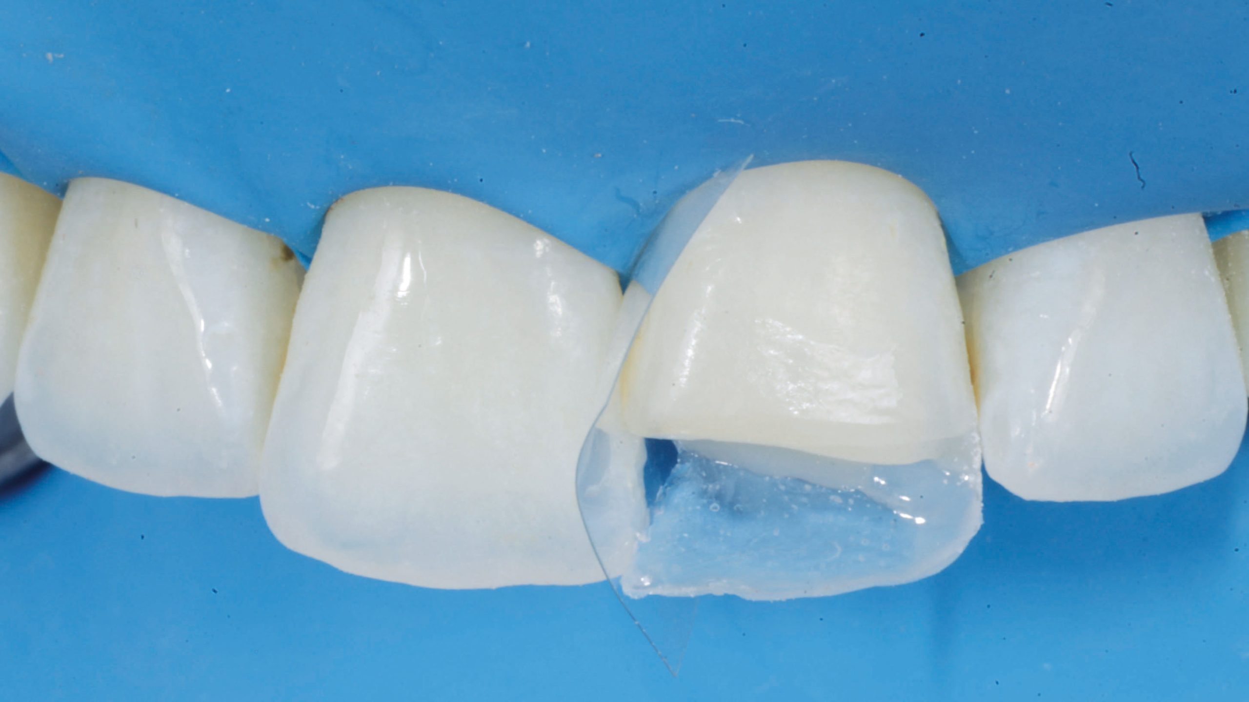Fig. 19 Creazione della parete palatina ed inserimento della matrice.