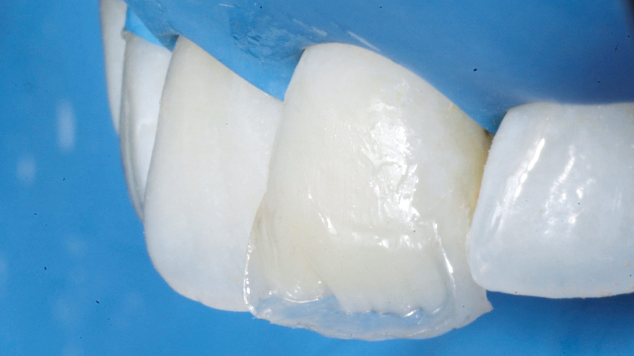 Fig. 27 Seconda massa dentinale A1 che disegna i mammelloni dentinali, lateralità destra.