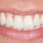 Fig. 40 Controllo a 6 mesi foto del sorriso frontale.