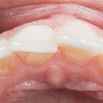 Fig. 44 Foto occlusale a 6 mesi.