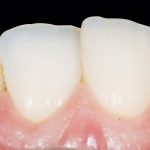 Fig. 45 Foto ad ore 12 a 6 mesi.