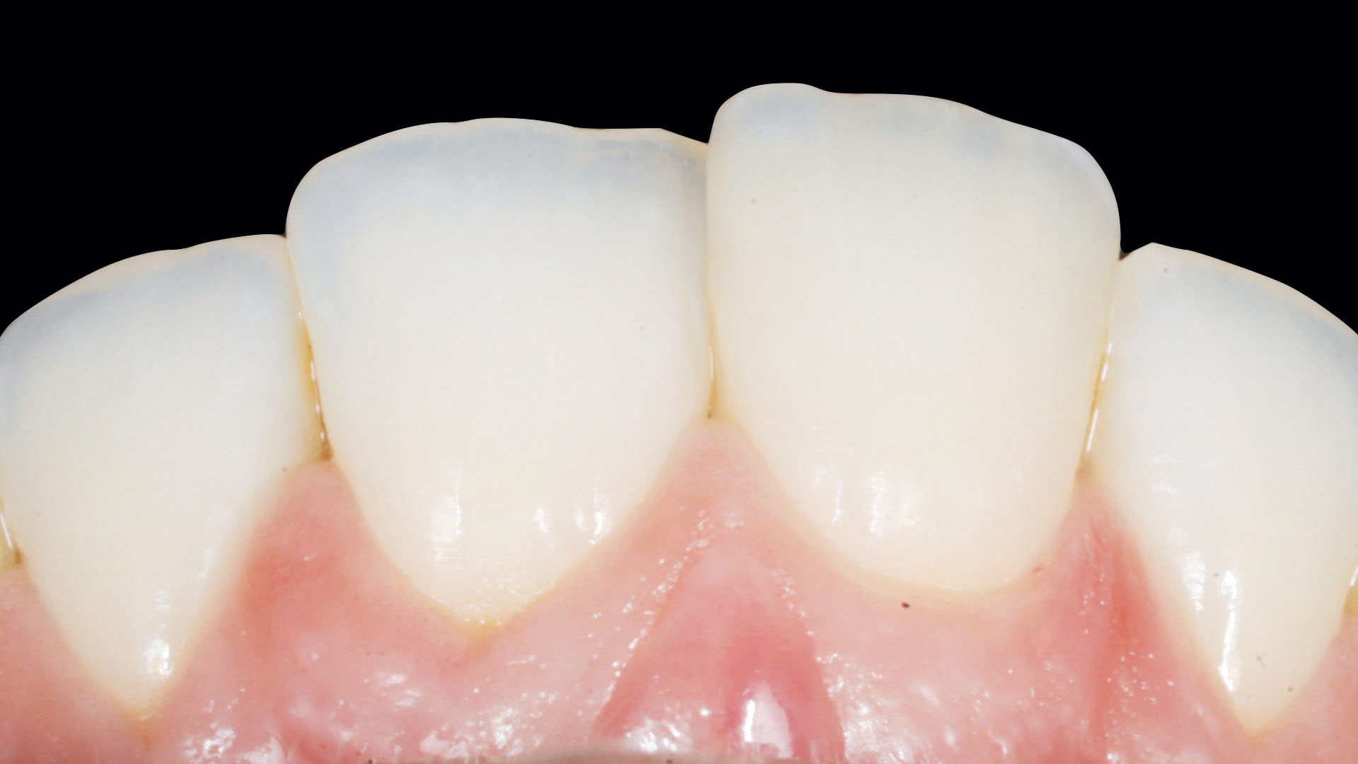 Fig. 45 Foto ad ore 12 a 6 mesi.