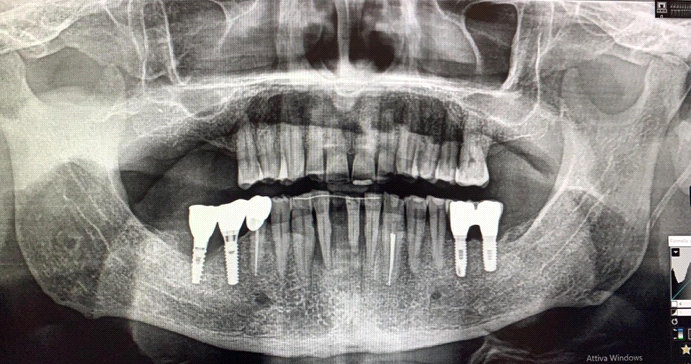 Fig. 1 Esame ortopantomografico di I livello.