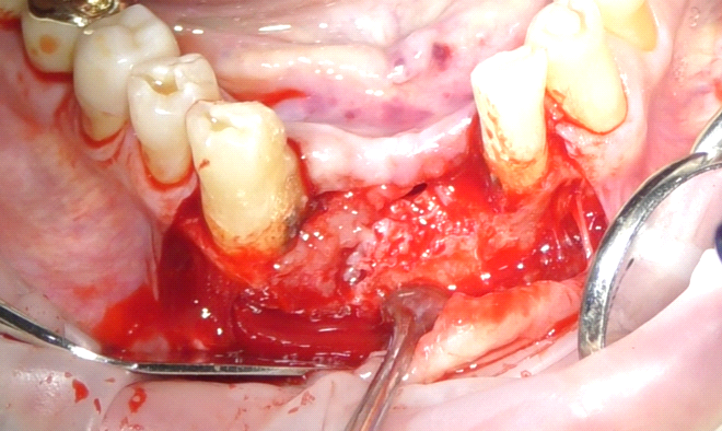 Fig. 2 Scollamento mucoperiosteo del lembo.