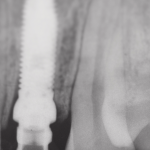 Fig. 3 Rx post-operatoria.