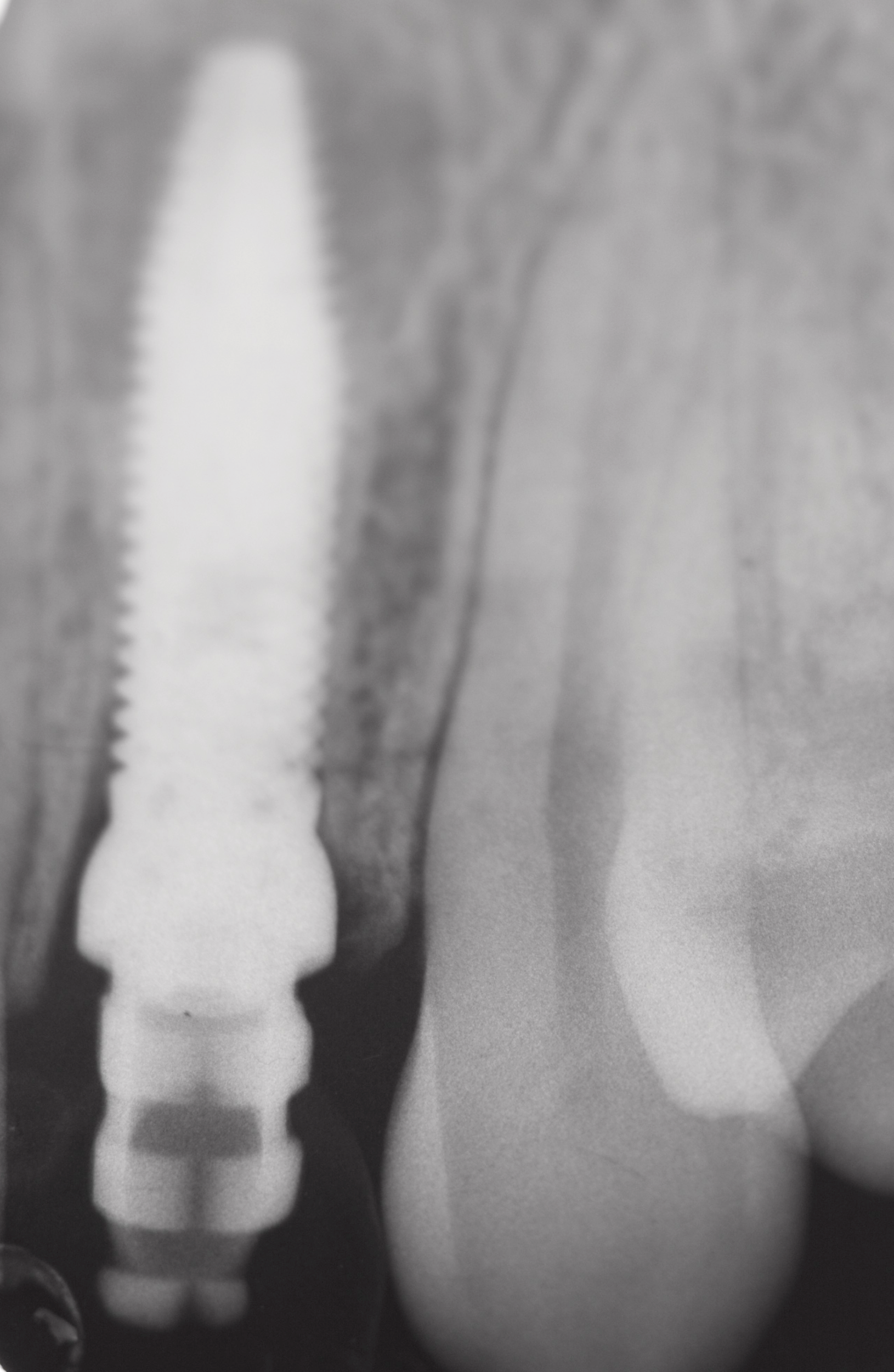 Fig. 3 Rx post-operatoria.