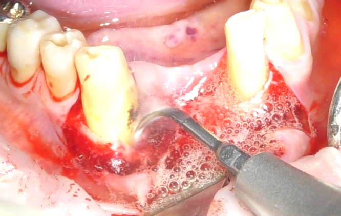 Fig. 3 Debridement meccanico con strumenti ultrasonici.