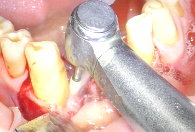Fig. 4 Debridement meccanico con fresa.