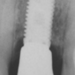 Fig. 5 Rx post guarigione.