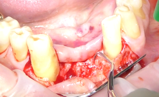 Fig. 5 Completamento del debridement meccanico con strumenti manuali.