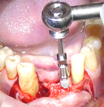 Fig. 6 Posizionamento chirurgico implantare.