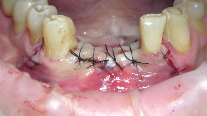 Fig. 10 Suture del lembo dopo il suo riposizionamento.