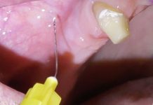 Inserzione di tre impianti in zona edentula di mascellare superiore: un case report Fig. 1 Dettaglio dell’anestesia plessica nel fornice buccale all’area edentula.