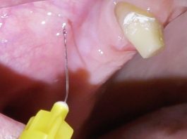 Fig. 1 Dettaglio dell’anestesia plessica nel fornice buccale all’area edentula.