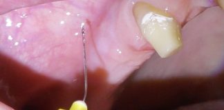 Fig. 1 Dettaglio dell’anestesia plessica nel fornice buccale all’area edentula.