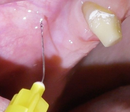 Fig. 1 Dettaglio dell’anestesia plessica nel fornice buccale all’area edentula.