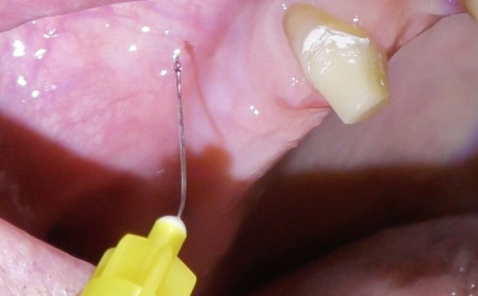 Fig. 1 Dettaglio dell’anestesia plessica nel fornice buccale all’area edentula. Fig. 1 Dettaglio dell’anestesia plessica nel fornice buccale all’area edentula.