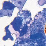 L’odontoiatria e le reazioni avverse a farmaci delle mucose orali