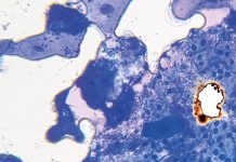 L’odontoiatria e le reazioni avverse a farmaci delle mucose orali