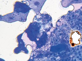L’odontoiatria e le reazioni avverse a farmaci delle mucose orali L’odontoiatria e le reazioni avverse a farmaci delle mucose orali